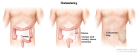 Colon cancer surgery with colostomy