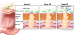 Stage II colon cancer