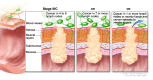 Stage IIIC colon cancer