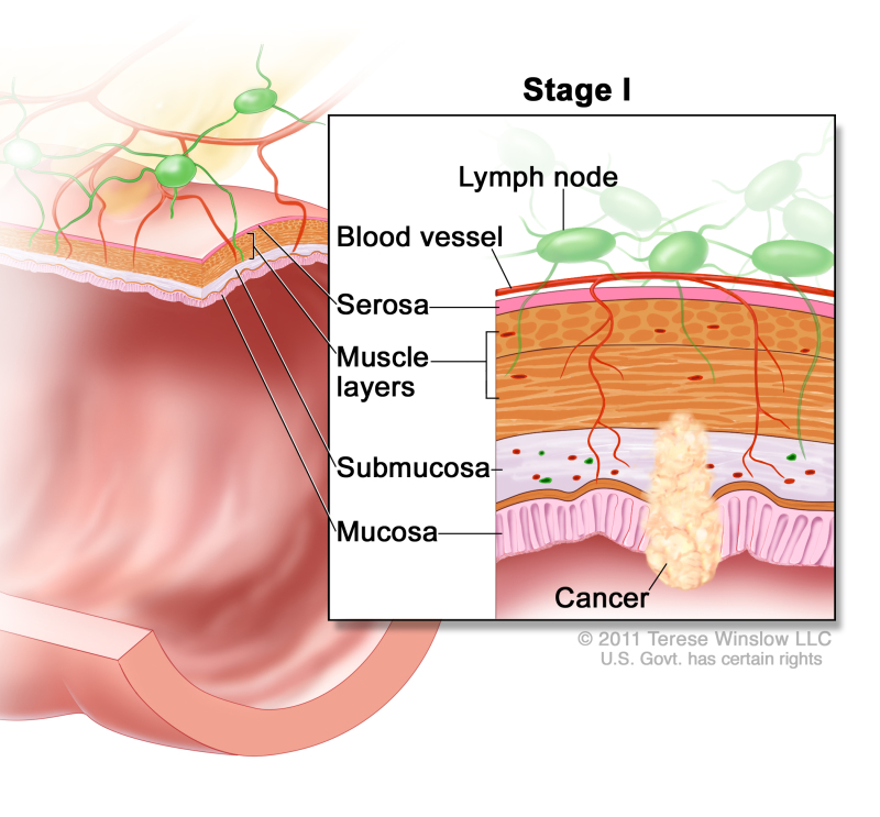 Stage I colorectal cancer; shows a cross-section of the colon/rectum. An inset shows the layers of the colon/rectum wall with cancer in the mucosa, submucosa, and muscle layers. Also shown are the serosa, a blood vessel, and lymph nodes.