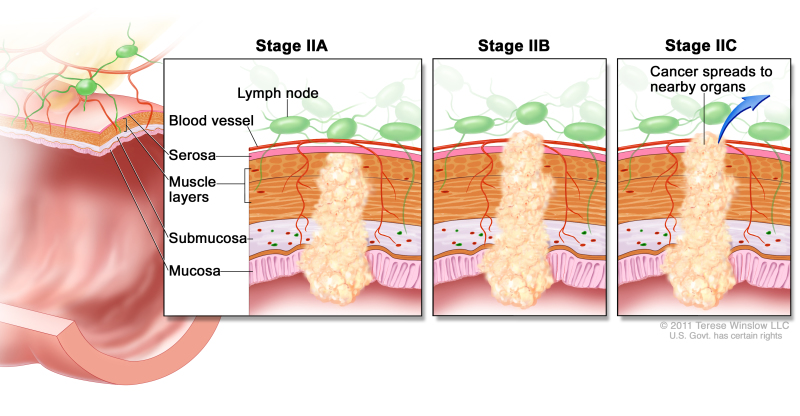 Stage II colorectal cancer; shows a cross-section of the colon/rectum and a three-panel inset. Each panel shows the layers of the colon/rectum wall: mucosa, submucosa, muscle layers, and serosa. Also shown are a blood vessel and lymph nodes. First panel shows stage IIA with cancer in the mucosa, submucosa, muscle layers, and serosa. Second panel shows stage IIB with cancer in all layers and spreading through the serosa. Third panel shows stage IIC with cancer spreading to nearby organs.