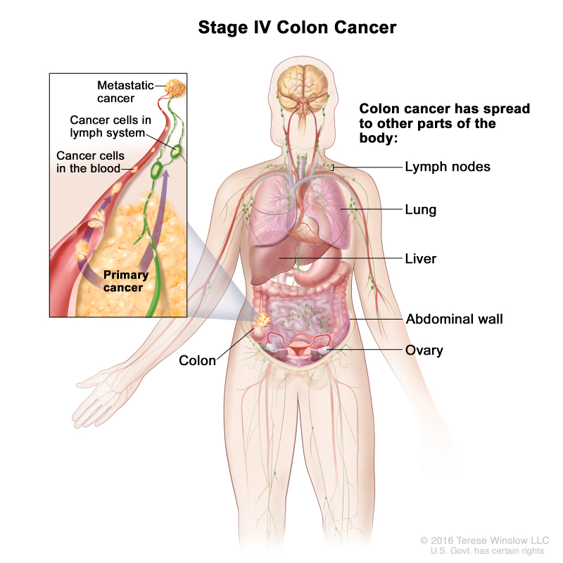 Stage IV colon cancer; drawing shows other parts of the body where colon cancer may spread, including the lymph nodes, lung, liver, abdominal wall, and ovary. An inset shows cancer cells spreading from the colon, through the blood and lymph system, to another part of the body where metastatic cancer has formed.