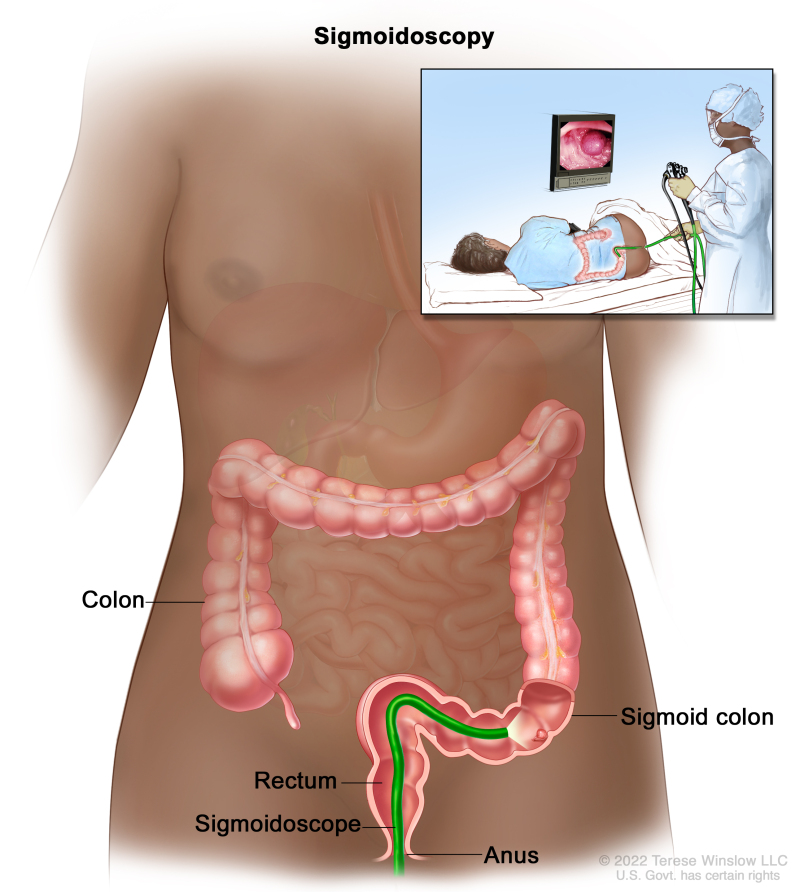 Sigmoidoscopy; drawing shows a sigmoidoscope inserted through the anus and rectum and into the sigmoid colon. An inset shows a patient lying on a table having a sigmoidoscopy.