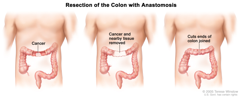 Three-panel drawing showing colon cancer surgery with anastomosis; first panel shows the area of the colon with cancer, middle panel shows the cancer and nearby tissue removed, last panel shows the cut ends of the colon joined.