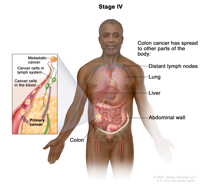 Stage IV colon cancer; drawing shows other parts of the body where colon cancer may spread, including the distant lymph nodes, lung, liver, and abdominal wall. An inset shows cancer cells spreading from the colon, through the blood and lymph system, to another part of the body where metastatic cancer has formed.