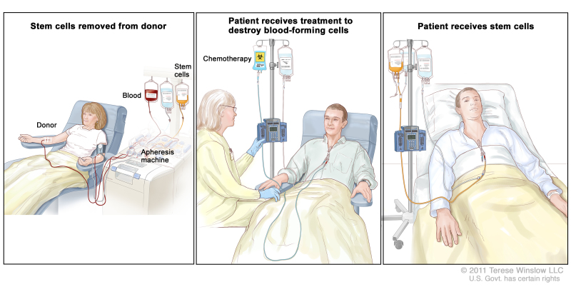 Stem cell transplant; (Panel 1): Drawing of stem cells being removed from a patient or donor. Blood is collected from a vein in the arm and flows through a machine that removes the stem cells; the remaining blood is returned to a vein in the other arm. (Panel 2): Drawing of a health care provider giving a patient treatment to kill blood-forming cells. Chemotherapy is given to the patient through a catheter in the chest. (Panel 3): Drawing of stem cells being given to the patient through a catheter in the chest.