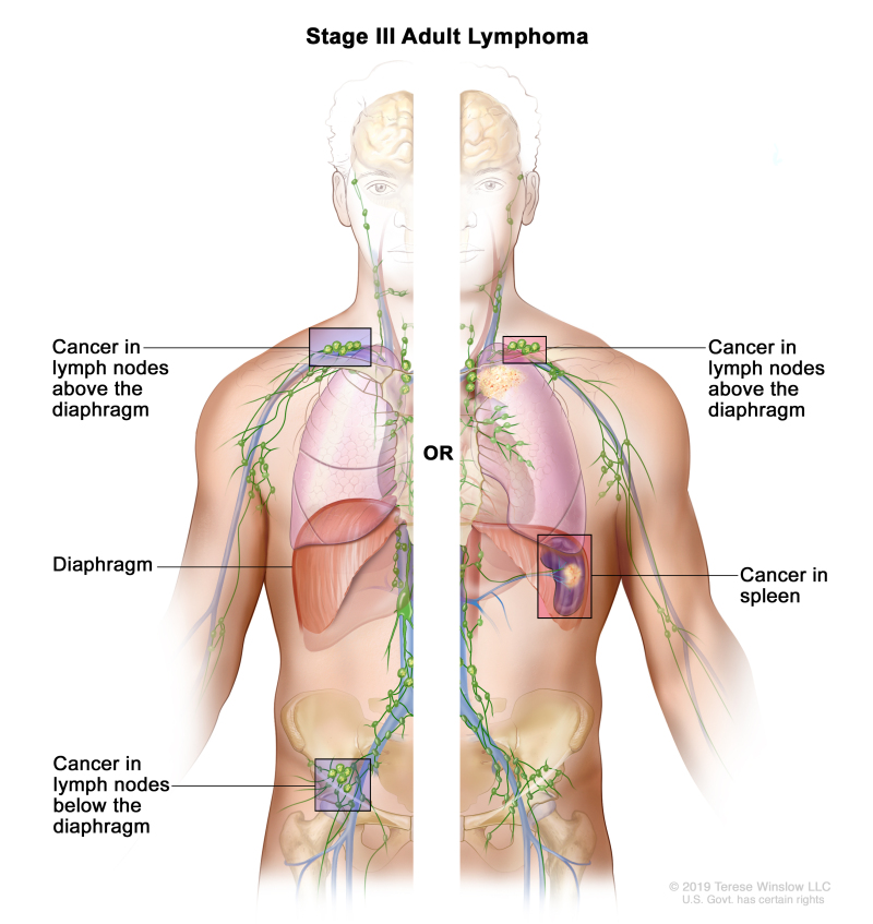 Stage III adult lymphoma; drawing shows the right and left sides of the body. The right side of the body shows cancer in a group of lymph nodes above the diaphragm and below the diaphragm. The left side of the body shows cancer in a group of lymph nodes above the diaphragm and cancer in the spleen.