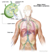 Stage I adult non-Hodgkin lymphoma