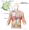 Stage II adult non-Hodgkin lymphoma