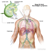 Stage IIE adult non-Hodgkin lymphoma