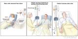 Stem cell transplant