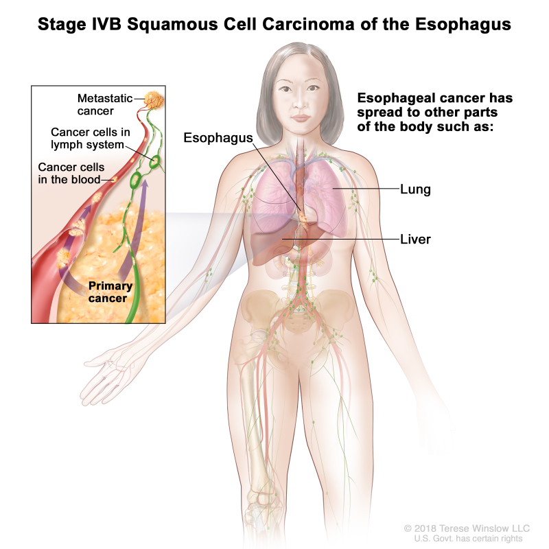 Stage IVB squamous cell carcinoma of the esophagus; drawing shows other parts of the body where esophagus cancer may spread, including the lung and liver. An inset shows cancer cells spreading from the esophagus, through the blood and lymph system, to another part of the body where metastatic cancer has formed.