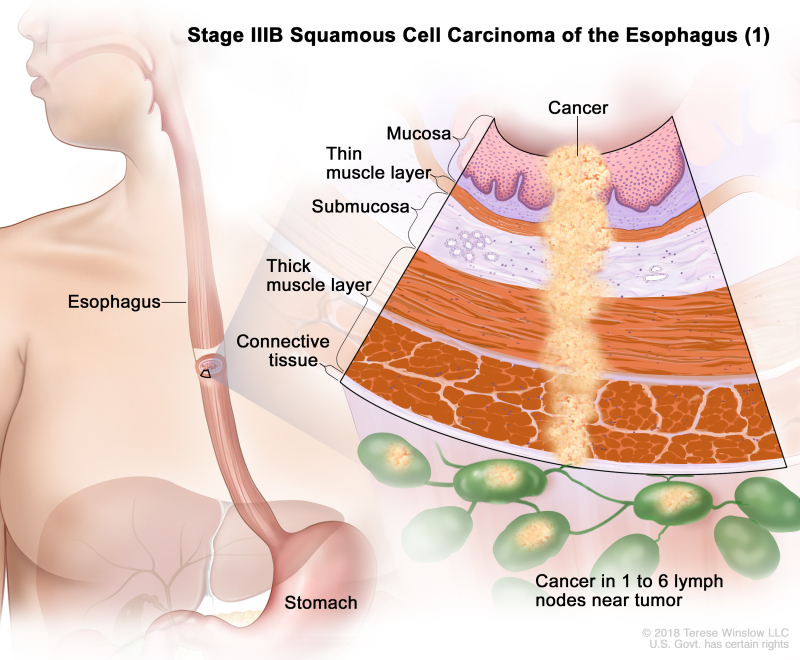 Stage IIIB squamous cell carcinoma of the esophagus (1); drawing shows the esophagus and stomach. An inset shows cancer cells in the mucosa layer, thin muscle layer, submucosa layer, thick muscle layer, and connective tissue layer of the esophagus wall and in 4 lymph nodes near the tumor.