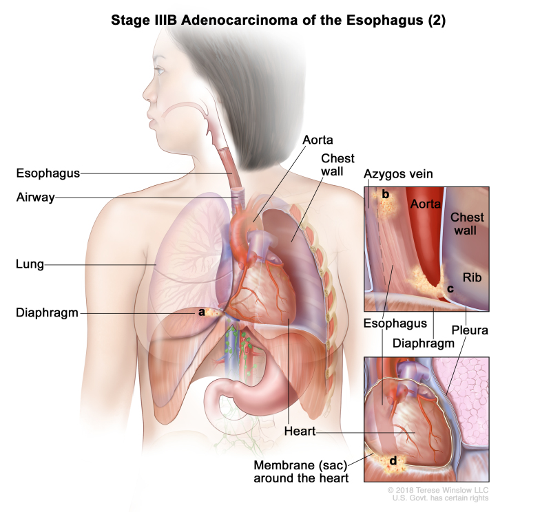 Stage IIIB adenocarcinoma of the esophagus (2); drawing shows cancer in the esophagus and in the (a) diaphragm, (b) azygos vein, (c) pleura, and (d) membrane (sac) around the heart. Also shown are the airway, lung, aorta, chest wall, heart, and rib.