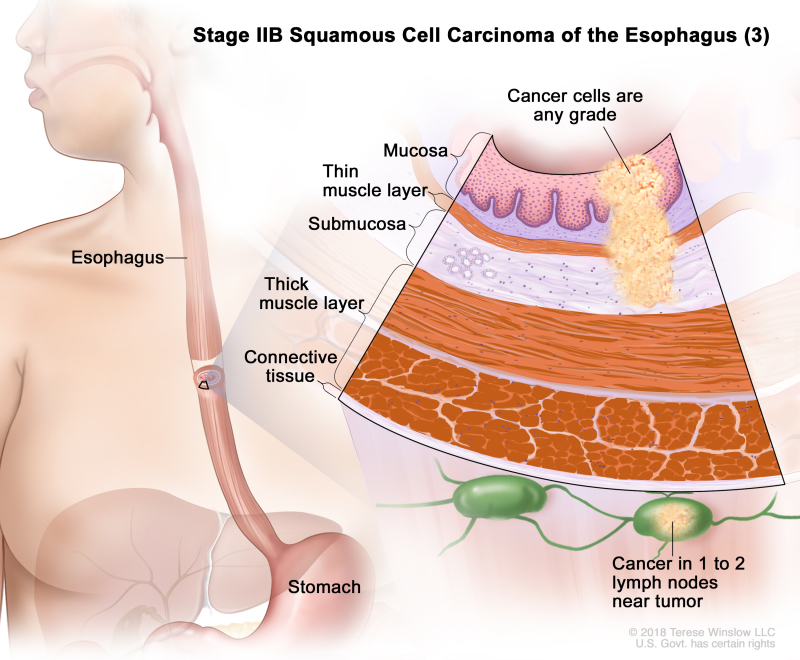 Stage IIB squamous cell carcinoma of the esophagus (3); drawing shows the esophagus and stomach. An inset shows cancer cells of any grade in the mucosa layer, thin muscle layer, and submucosa layer of the esophagus wall. Also shown are the thick muscle layer and connective tissue layer of the esophagus wall and cancer in 1 lymph node near the tumor.