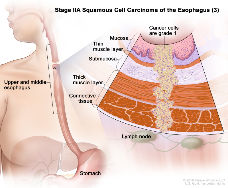 Stage IIA squamous cell carcinoma of the esophagus (3); drawing shows the upper and middle parts of the esophagus and the stomach. An inset shows grade 1 cancer cells in the mucosa layer, thin muscle layer, submucosa layer, thick muscle layer, and connective tissue layer of the upper and middle esophagus wall. The lymph nodes are also shown.