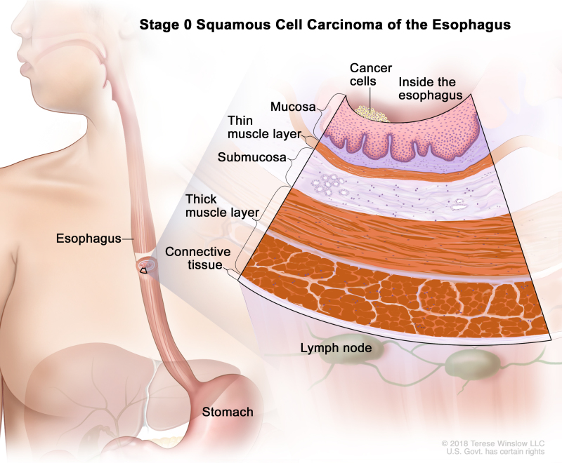 Stage 0 squamous cell carcinoma of the esophagus; drawing shows the esophagus and stomach. An inset shows cancer cells in the inner lining of the esophagus wall. Also shown are the mucosa layer, thin muscle layer, submucosa layer, thick muscle layer, and connective tissue layer of the esophagus wall. The lymph nodes are also shown.