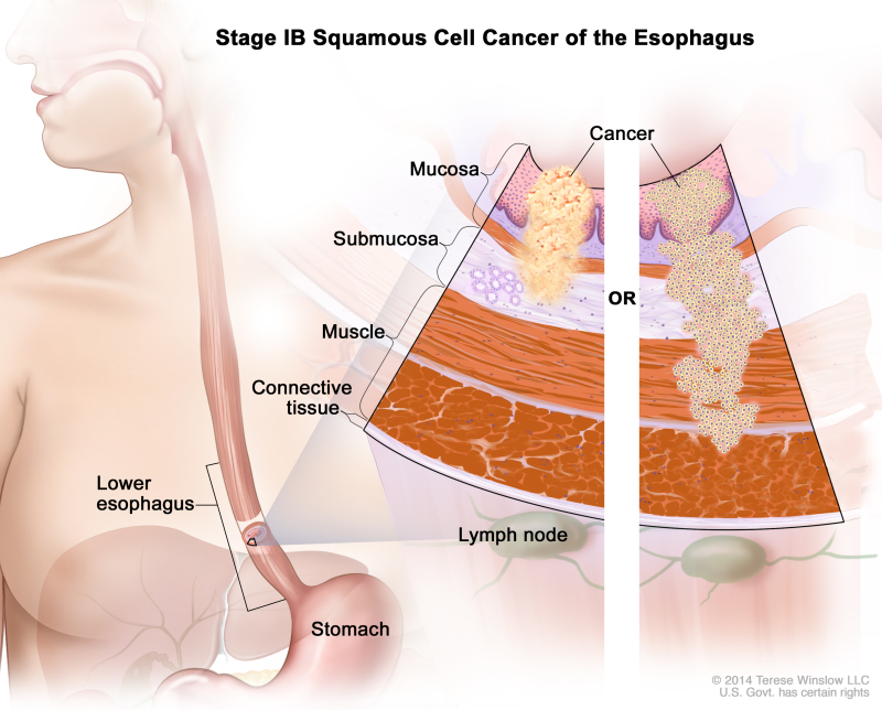 Stage IB squamous cell cancer of the esophagus; drawing shows the esophagus and stomach. A two-panel inset shows the layers of the esophagus wall: the mucosa, submucosa, muscle, and connective tissue layers. Also shown are lymph nodes. The left panel shows cancer in the mucosa and submucosa layers. The right panel shows cancer in the mucosa, submucosa, and muscle layers.