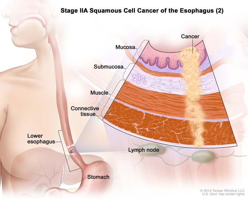 Stage IIA squamous cell cancer of the esophagus (2); drawing shows the esophagus and stomach. An inset shows the layers of the esophagus wall with cancer in the mucosa, submucosa, muscle, and connective tissue layers. Also shown are lymph nodes.