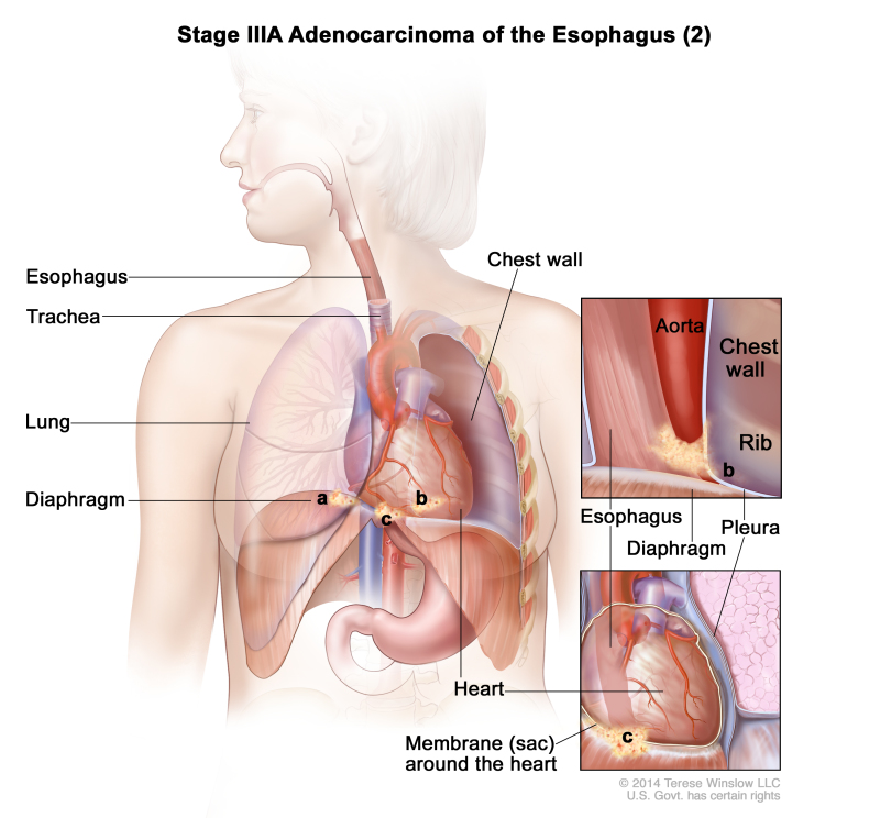 Stage IIIA adenocarcinoma of the esophagus (2); drawing shows the esophagus, trachea, and lung. The top inset shows cancer that has spread from the esophagus into the diaphragm and pleura; the aorta, chest wall, and rib are also shown. The bottom inset shows cancer that has spread from the esophagus into the membrane (sac) around the heart.