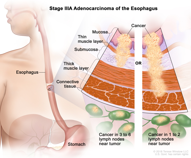 Stage IIIA adenocarcinoma of the esophagus; drawing shows the esophagus and stomach. A two-panel inset shows the layers of the esophagus wall: the mucosa layer, thin muscle layer, submucosa layer, thick muscle layer, and connective tissue layer. The left panel shows cancer in the mucosa layer, thin muscle layer, and submucosa layer and in 3 lymph nodes near the tumor. The right panel shows cancer in the mucosa layer, thin muscle layer, submucosa layer, and thick muscle layer and in 1 lymph node near the tumor.