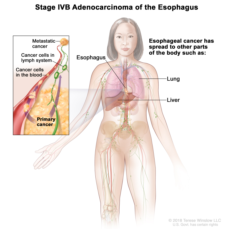 Stage IVB adenocarcinoma of the esophagus; drawing showing other parts of the body where esophagus cancer may spread, including the lung and liver. An inset shows cancer cells spreading from the esophagus, through the blood and lymph system, to another part of the body where metastatic cancer has formed.