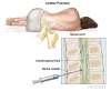 Lumbar puncture