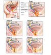 As prostate cancer progresses from Stage I to Stage IV, the cancer cells grow within the prostate, through the outer layer of the prostate into nearby tissue, and then to lymph nodes or other parts of the body