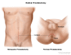 Two types of radical prostatectomy