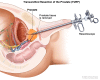 Transurethral resection of the prostate (TURP)