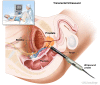 Transrectal ultrasound