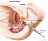 Transrectal biopsy