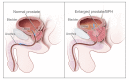 Normal prostate and benign prostatic hyperplasia (BPH)