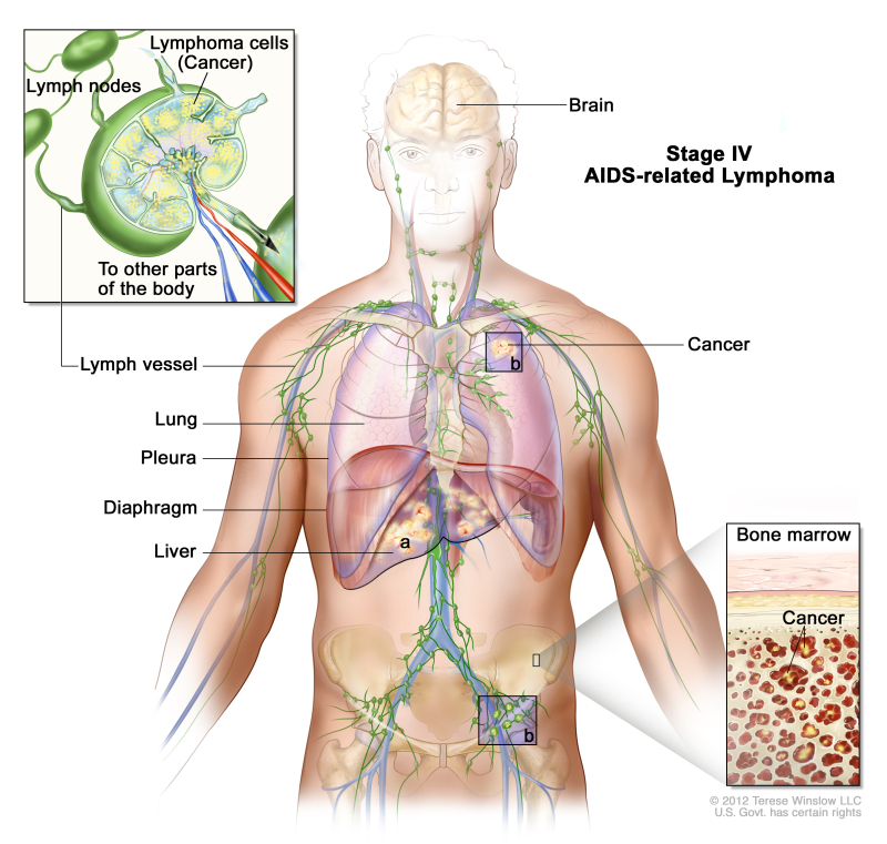 Stage IV AIDS-related lymphoma; drawing shows cancer in the liver, the left lung, and in one lymph node group below the diaphragm. The brain and pleura are also shown. One inset shows a close-up of cancer spreading through lymph nodes and lymph vessels to other parts of the body. Lymphoma cells containing cancer are shown inside one lymph node. Another inset shows cancer cells in the bone marrow.