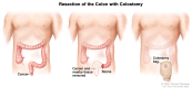 Resection of the colon with colostomy