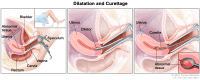 Dilatation and curettage (D and C)
