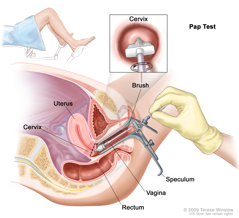 Pap test; drawing shows a side view of the female reproductive anatomy during a Pap test. A speculum is shown widening the opening of the vagina. A brush is shown inserted into the open vagina and touching the cervix at the base of the uterus. The rectum is also shown. One inset shows the brush touching the center of the cervix. A second inset shows a woman covered by a drape on an exam table with her legs apart and her feet in stirrups.