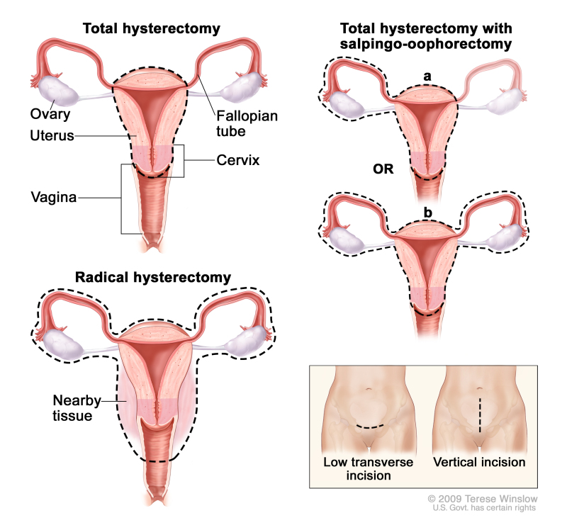 Hysterectomy; drawing shows the female reproductive anatomy, including the ovaries, uterus, vagina, fallopian tubes, and cervix. Dotted lines show which organs and tissues are removed in a total hysterectomy, a total hysterectomy with salpingo-oophorectomy, and a radical hysterectomy. An inset shows the location of two possible incisions on the abdomen: a low transverse incision is just above the pubic area and a vertical incision is between the navel and the pubic area.