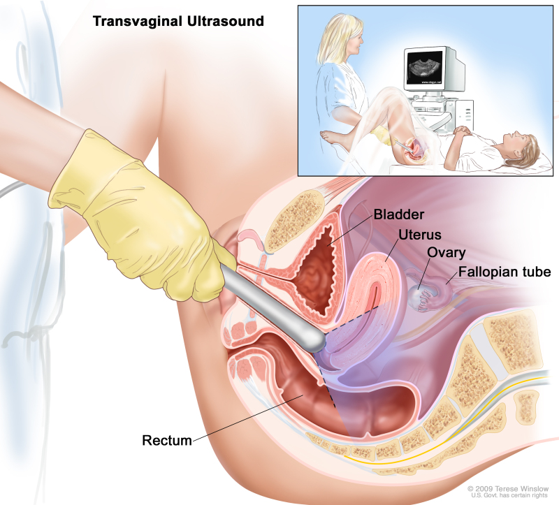 Transvaginal ultrasound; drawing shows a side view of the female reproductive anatomy during a transvaginal ultrasound procedure. An ultrasound probe (a device that makes sound waves that bounce off tissues inside the body) is shown inserted into the vagina. The bladder, uterus, right fallopian tube, and right ovary are also shown. The inset shows the diagnostic sonographer (a person trained to perform ultrasound procedures) examining a woman on a table, and a computer screen shows an image of the patient’s internal tissues.
