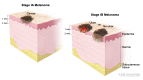 Stage I melanoma