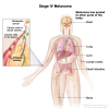 Stage IV melanoma