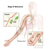 Stage III melanoma