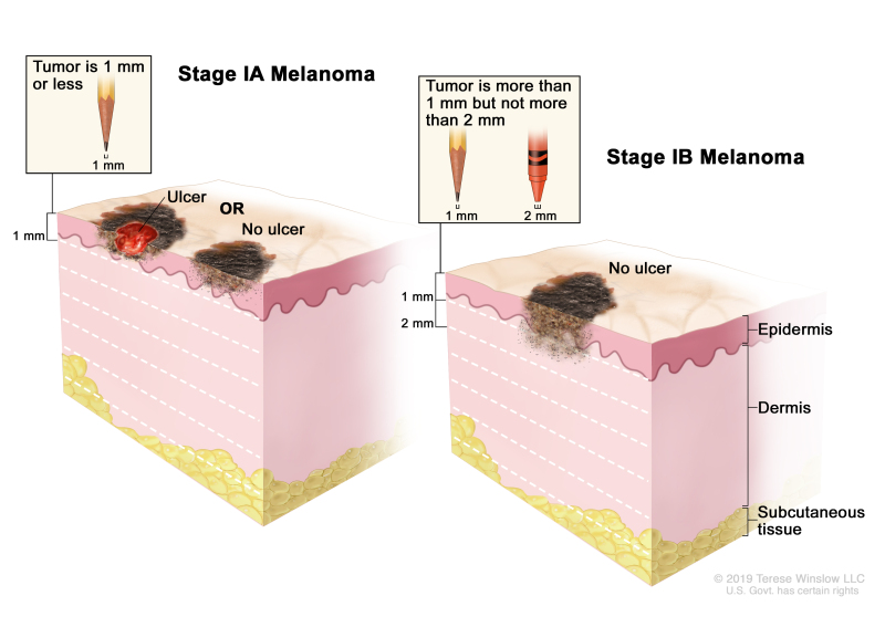 Two-panel drawing of stage I melanoma; the panel on the left shows a stage IA tumor that is not more than 1 millimeter thick, with ulceration (a break in the skin) and without ulceration. The panel on the right shows a stage IB tumor that is more than 1 but not more than 2 millimeters thick, without ulceration. Also shown are the epidermis (outer layer of the skin), the dermis (inner layer of the skin), and the subcutaneous tissue below the dermis.