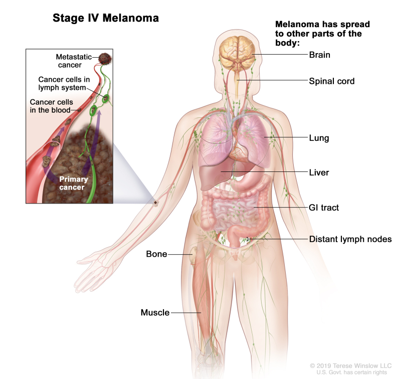 Stage IV melanoma; drawing shows other parts of the body where melanoma may spread, including the brain, spinal cord, lung, liver, gastrointestinal (GI) tract, bone, muscle, and distant lymph nodes. An inset shows cancer cells spreading through the blood and lymph system to another part of the body where a metastatic tumor has formed.