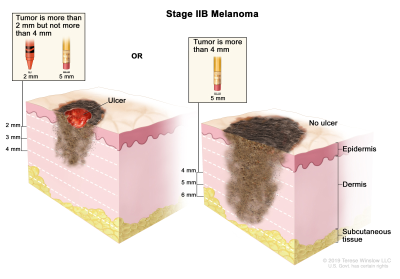 Two-panel drawing of stage IIB melanoma; the panel on the left shows a tumor that is more than 2 but not more than 4 millimeters thick, with ulceration (a break in the skin). The panel on the right shows a tumor that is more than 4 millimeters thick, without ulceration. Also shown are the epidermis (outer layer of the skin), the dermis (inner layer of the skin), and the subcutaneous tissue below the dermis.