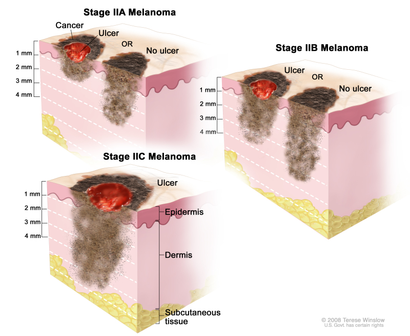 Three-panel drawing of stage II melanoma. The left panel shows two stage IIA tumors. One tumor is more than 1 but not more than 2 millimeters thick, with ulceration (break in the skin); the other tumor is more than 2 but not more than 4 millimeters thick, with no ulceration. The right panel shows two stage IIB tumors. One tumor is more than 2 but not more than 4 millimeters thick, with ulceration; the other tumor is more than 4 millimeters thick, with no ulceration. The bottom panel shows a stage IIC tumor that is more than 4 millimeters thick, with ulceration. Also shown are the epidermis (outer layer of the skin), the dermis (inner layer of the skin), and the subcutaneous tissue below the dermis.