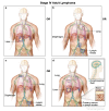 Stage IV adult lymphoma