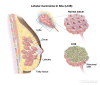 Lobular carcinoma in situ (LCIS)