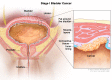 Stage I bladder cancer (non-muscle-invasive bladder cancer)