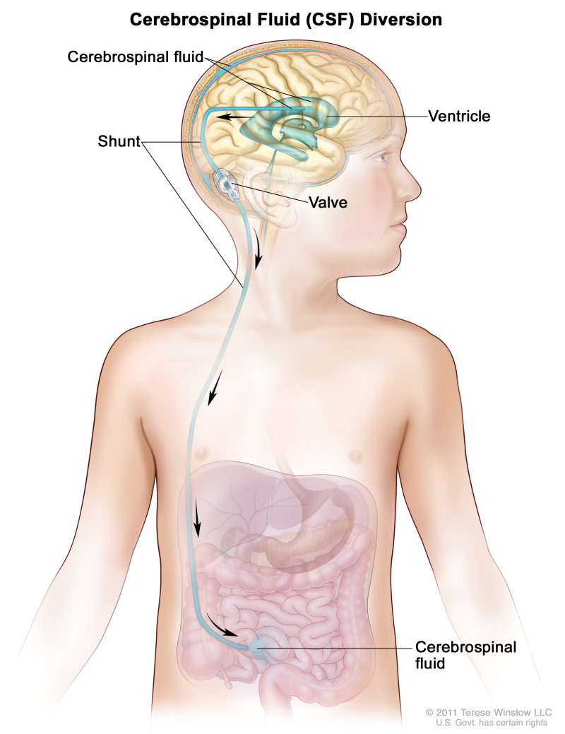 Cerebrospinal fluid (CSF) diversion; drawing shows extra CSF flowing through a tube (shunt) from a ventricle in the brain into the abdomen. The shunt goes from the ventricle, under the skin in the neck and chest, and into the abdomen. Also shown is a valve that controls the flow of CSF.